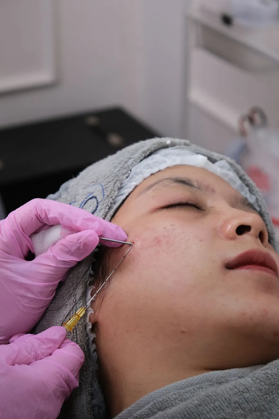 RF microneedling facial treatment procedure, illustrative image