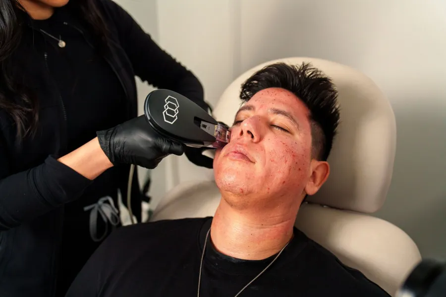 Advanced skin rejuvenation device treatment, illustrative image