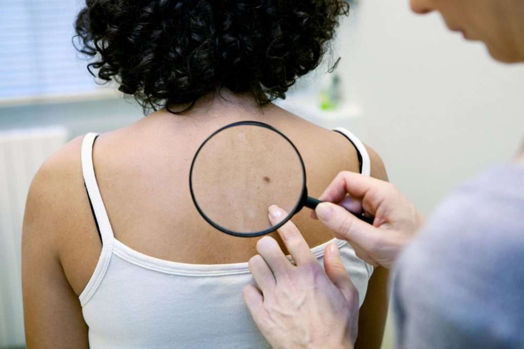 doctor looking at mole on woman