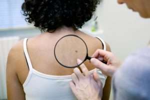 doctor looking at mole on woman