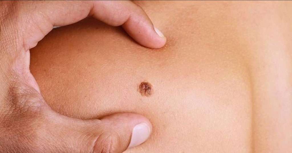 image of a mole that could be skin cancer