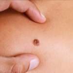 image of a mole that could be skin cancer | Dermatology of Seattle