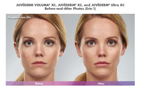 juvederm before and after | Dermatology of Seattle