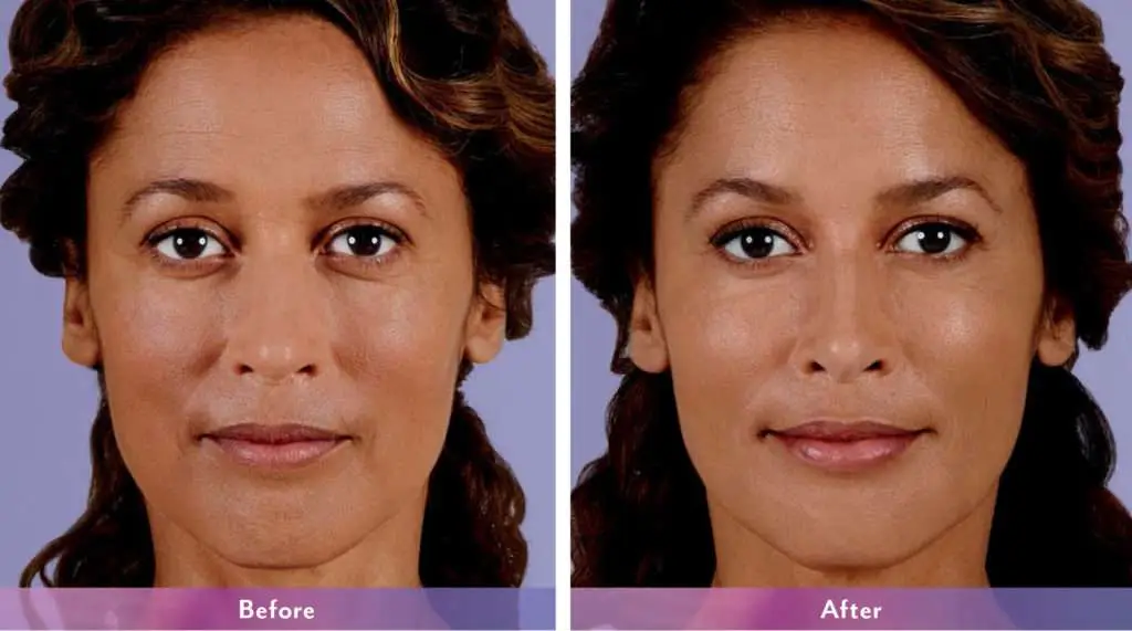 juvederm before and after