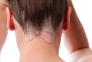 woman with eczema on neck