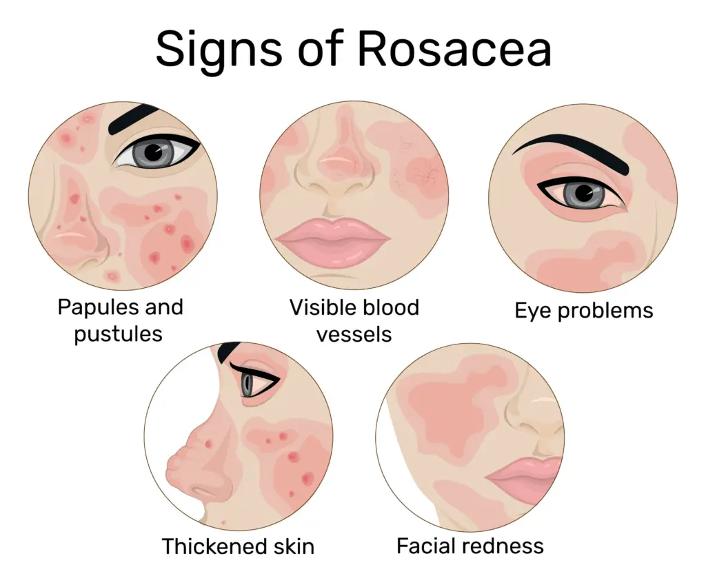 Illustrated signs of rosacea showing facial redness, bumps, vessels, eye issues
