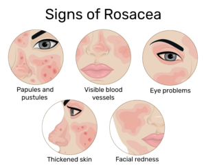 graphic of rosacea symptoms