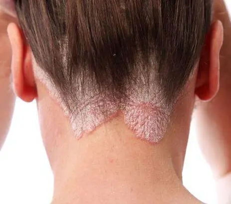 Red, scaly skin rash on back of person’s neck