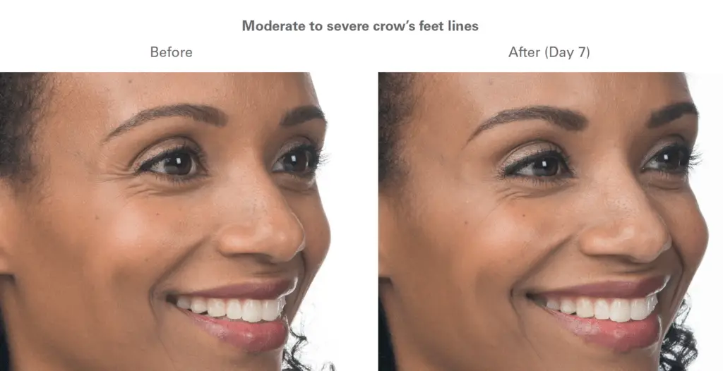 botox before and after