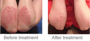 before and after image of psoriasis