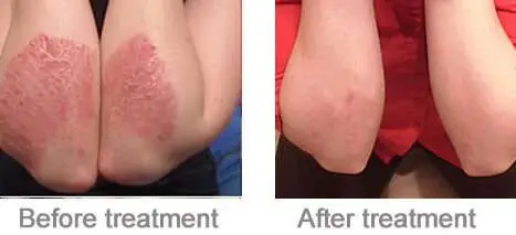 Side-by-side elbows before and after UVB skin treatment.