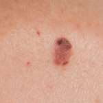 image of a mole | Dermatology of Seattle