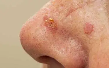 Close-up of an older person’s nose with two scaly lesions.