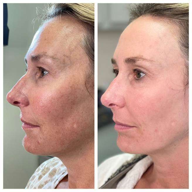 smoothglo before and after | Dermatology of Seattle