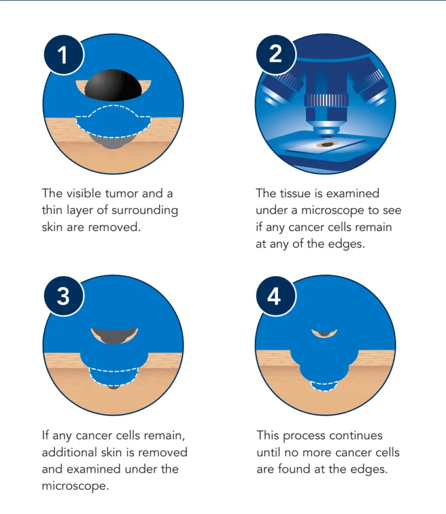 The four-step illustration of the cancer's removal process