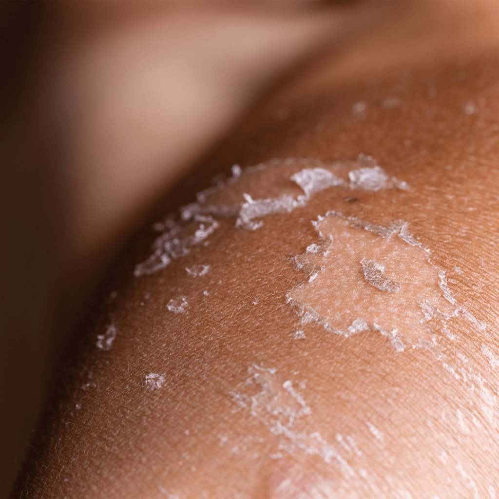 Close-up image of skin showing a dry, peeling area indicative of healing after a sunburn.