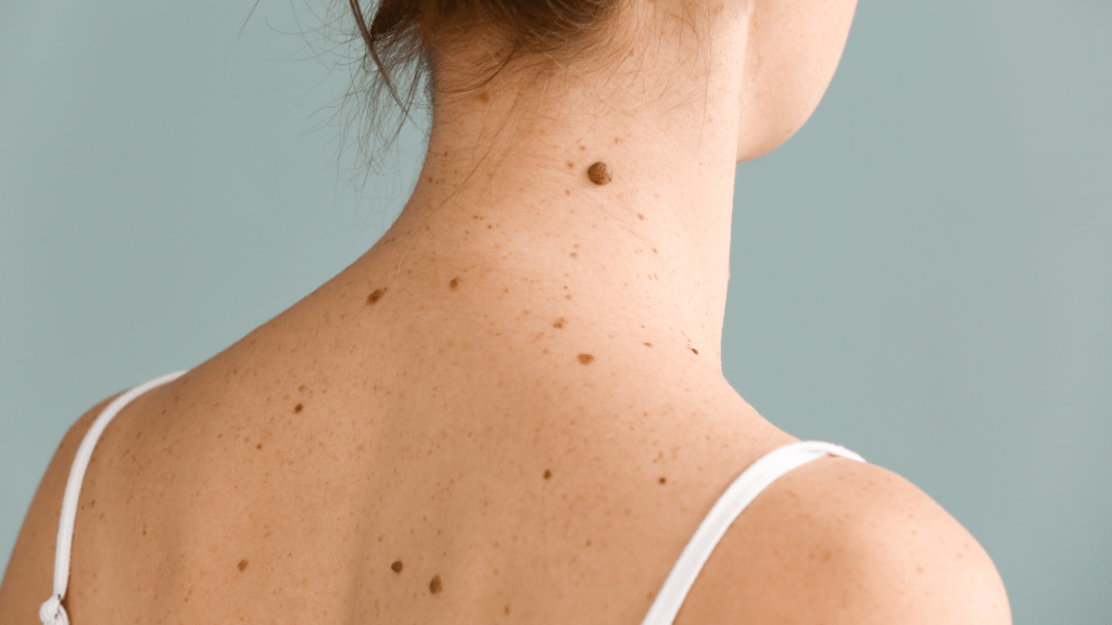 Moles on the back of a woman.