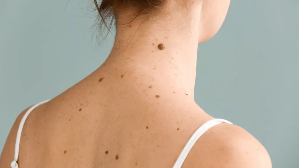 Back view of woman’s neck and shoulders with multiple moles.