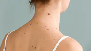 Back view of woman’s neck and shoulders with multiple moles.