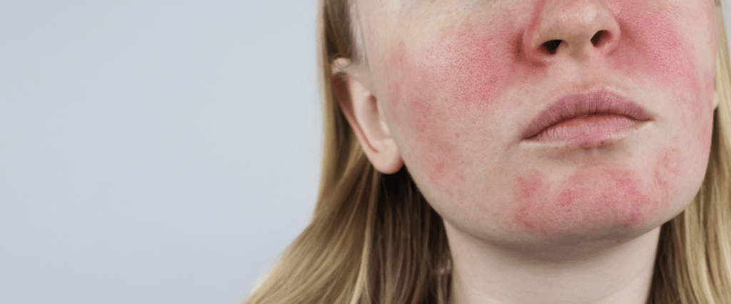 Close-up of a woman's face showing redness and inflammation on cheeks and nose indicative of a skin condition like rosacea.