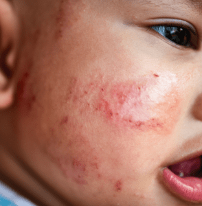 Close-up of a child's cheek showing symptoms of a skin rash or dermatitis.