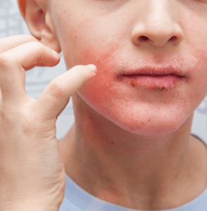 Person pointing to inflamed acne and blemishes on their lower face and chin area.