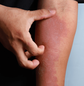 Individual scratching their inflamed and irritated forearm with visible skin rash.
