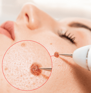 A dermatologist performing a procedure on a mole on a patient's skin, with a close-up view highlighting the mole within a red circle.