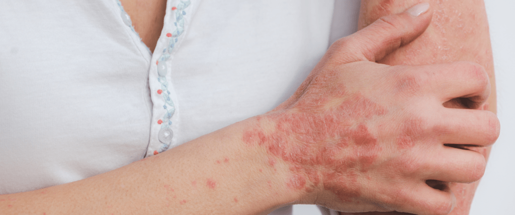 Person scratching an arm affected by severe eczema with visible red patches and inflamed skin