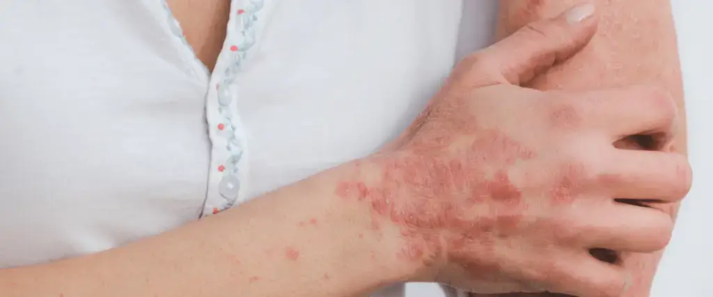 Person scratching an arm affected by severe eczema with visible red patches and inflamed skin