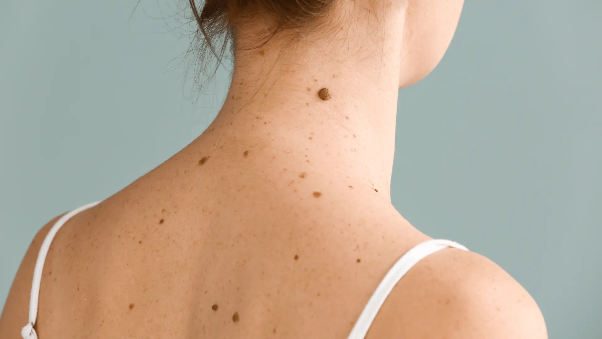 Back view of woman’s neck and shoulders with multiple moles.