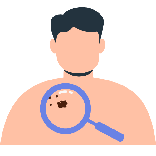 Illustration of a person facing forward with a magnifying glass over the neck area, enlarging a mole on the skin.
