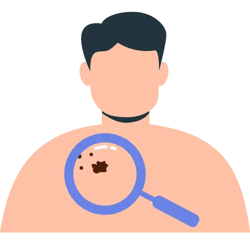 Illustration of a person facing forward with a magnifying glass over the neck area, enlarging a mole on the skin.