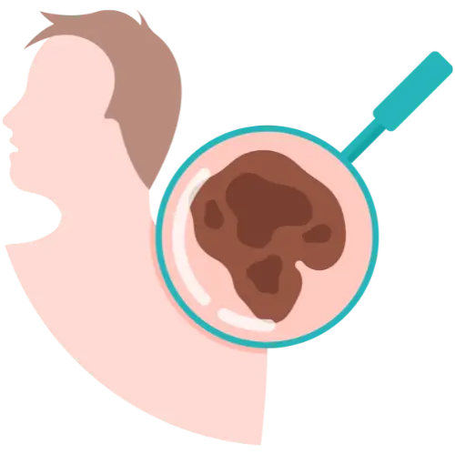 Illustration of a side profile of a person with a mole on their neck. The mole is highlighted and magnified to show detail, against a transparent background.