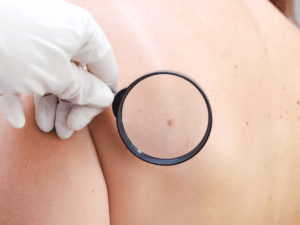 A dermatologist holding the magnifying glass better to see the mole on the patient's back