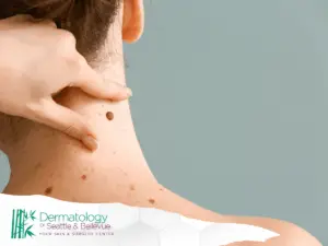A close-up image of a dermatologist's hand examining the mole on the back part of the neck