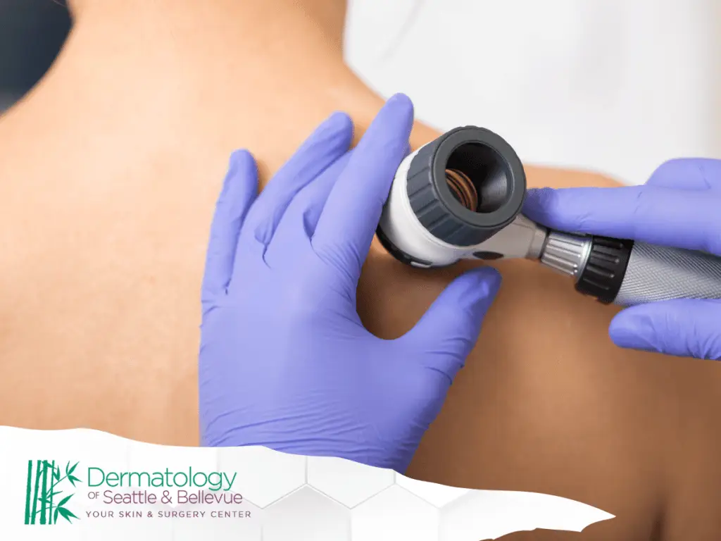 Dermatologist examining patient’s upper back mole with dermatoscope and gloves