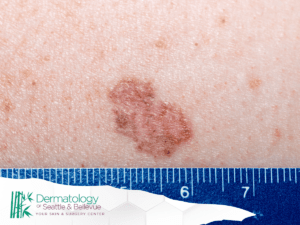 Close-up of a brown, scaly lesion on human skin with a ruler for scale, and the Dermatology of Seattle & Bellevue logo in the corner.