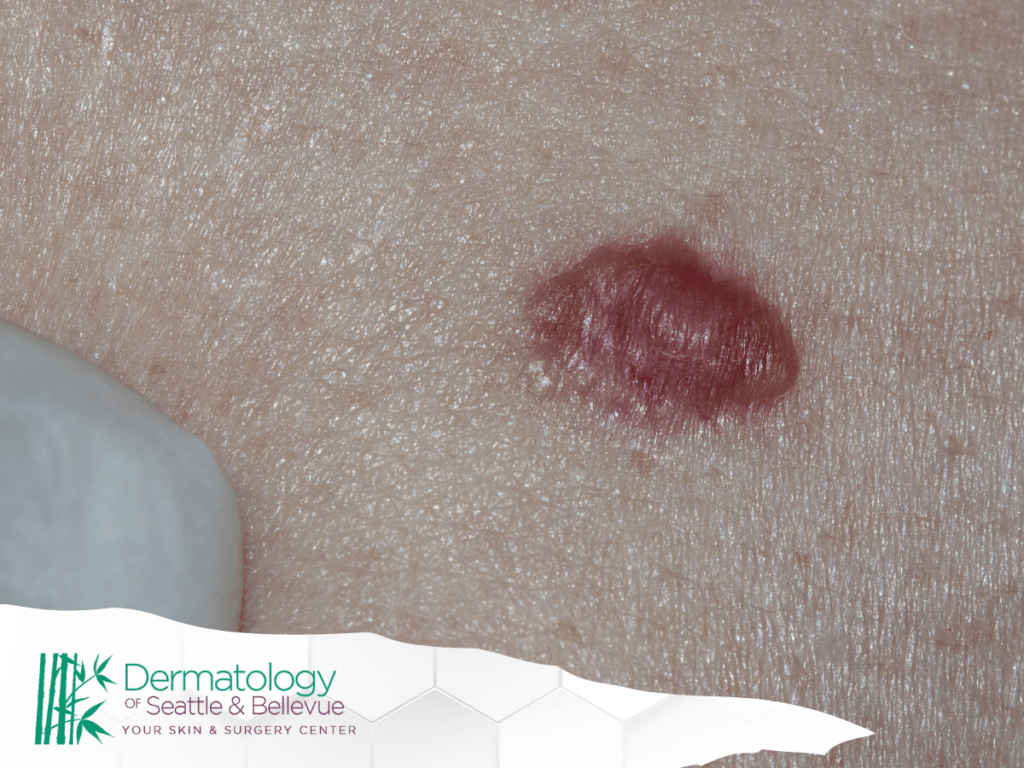 Close-up of a red, raised lesion on human skin, with the Dermatology of Seattle & Bellevue logo in the corner.