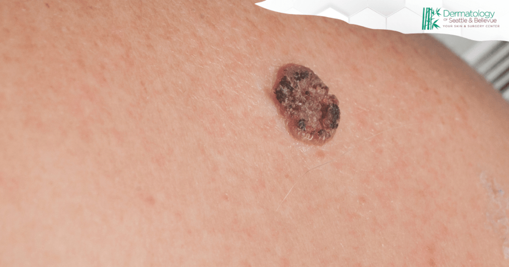 Close-up of a dark, scaly lesion on human skin, with the Dermatology of Seattle & Bellevue logo in the corner.