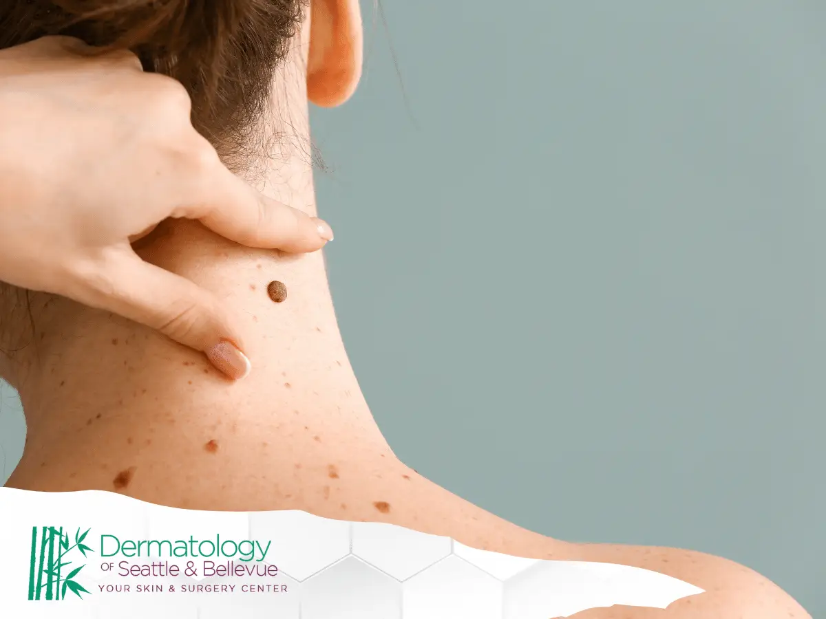 A close-up image of a dermatologist's hand examining the mole on the back part of the neck