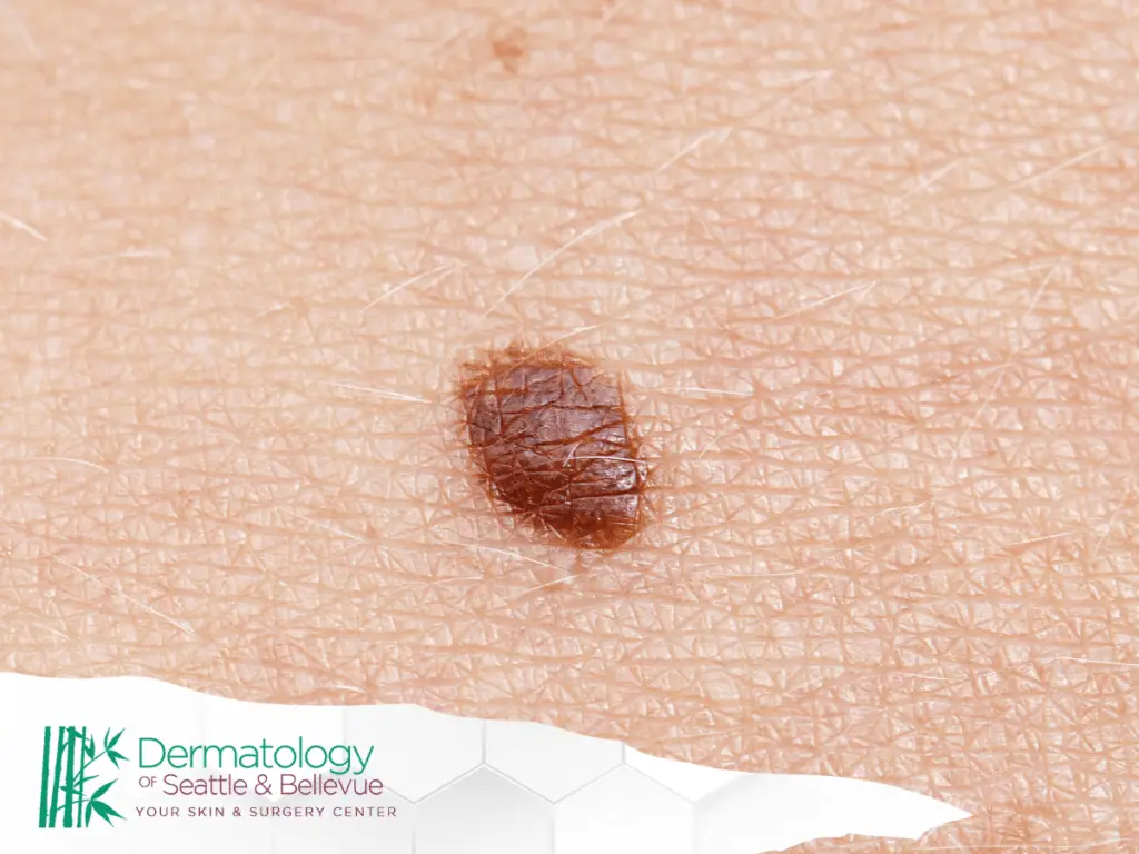 Close-up of a mole on human skin with the Dermatology of Seattle & Bellevue logo in the corner.