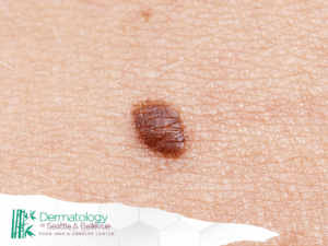 Close-up of a mole on human skin with the Dermatology of Seattle & Bellevue logo in the corner.