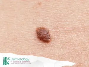 Close-up of a mole on human skin with the Dermatology of Seattle & Bellevue logo in the corner.