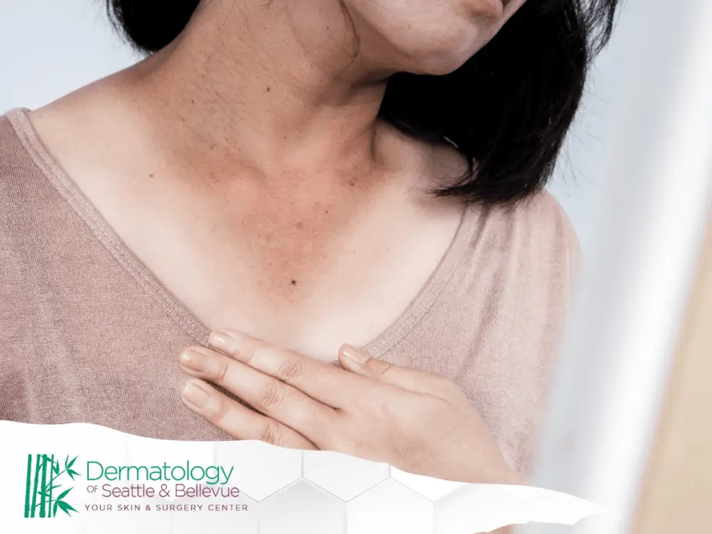 Close-up of a woman touching her chest, showing skin discoloration, with the Dermatology of Seattle & Bellevue logo in the corner.