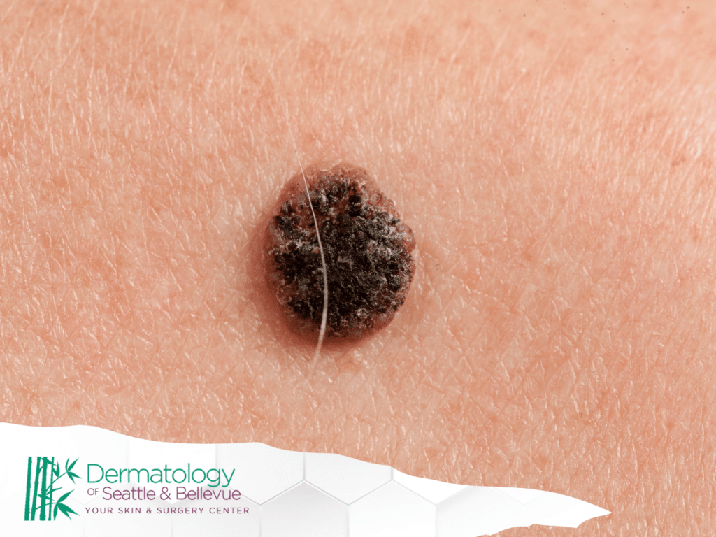 Close-up of a dark, raised mole on human skin with the Dermatology of Seattle & Bellevue logo in the corner.