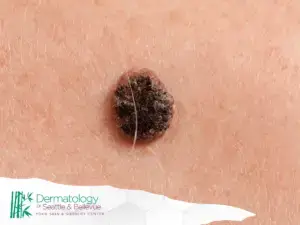 Close-up of a dark, raised mole on human skin with the Dermatology of Seattle & Bellevue logo in the corner.