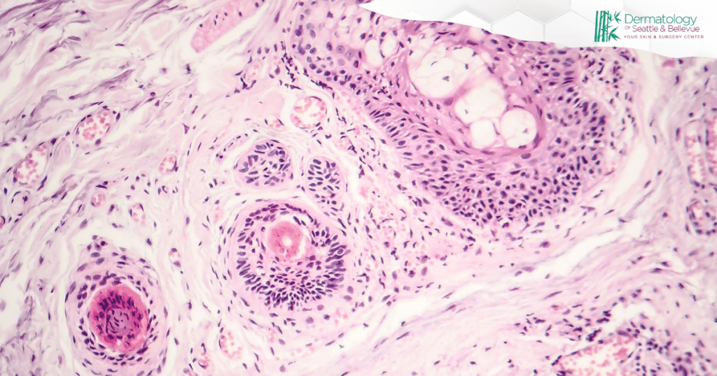 Microscopic view of skin tissue showing cellular structures, with the Dermatology of Seattle & Bellevue logo in the corner.