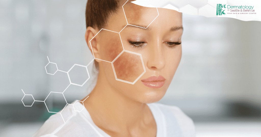 Close-up of a woman with hyperpigmentation on her cheek, with hexagonal graphics overlay and the Dermatology of Seattle & Bellevue logo in the corner.