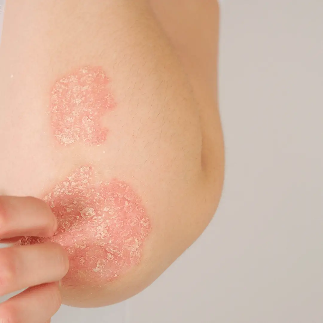 Peeling and flaky psoriasis patches on an elbow, showing a common autoimmune skin condition.
